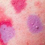 Fargefulle hudutslett fra erythema multiforme.
