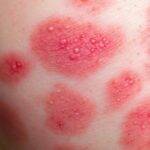 Medikamentutløst utslett på hudoverflaten.